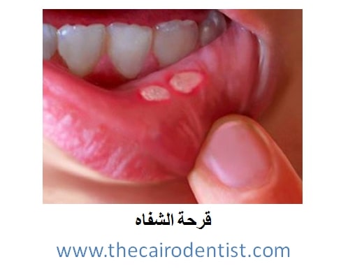 قرحة الفم