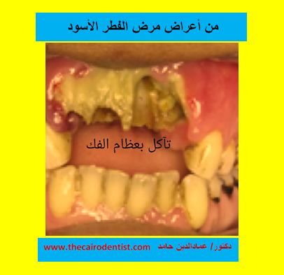 الفطر الأسود قد يسبب تآكل بعظام الفك الفطر الأسود قد يسبب تآكل بعظام الفك
