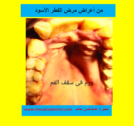 الفطر الأسود قد يسبب ورم بسقف الفم الفطر الأسود قد يسبب ورم بسقف الفم