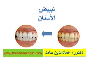 طرق تبييض الأسنان